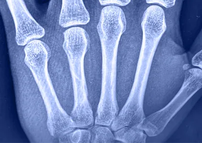 X-ray of 4th metacarpal fracture