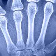 X-ray of 4th metacarpal fracture